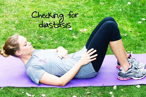 How do I know if I have diastasis recti?