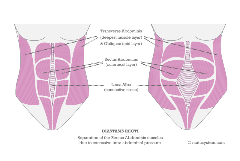 Baby fat or Diastasis Recti: Who is the Real Culprit? - Fitness 1 Gym