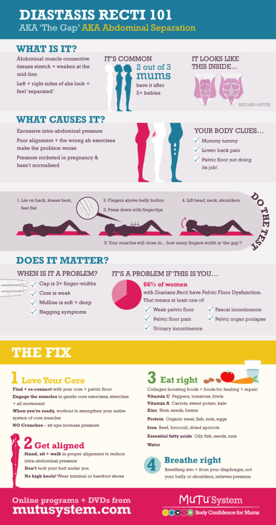 Diastasis Recti Infographic